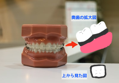 奥歯の矯正器具の参考図