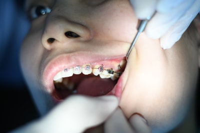 歯列矯正治療を受ける人の口元