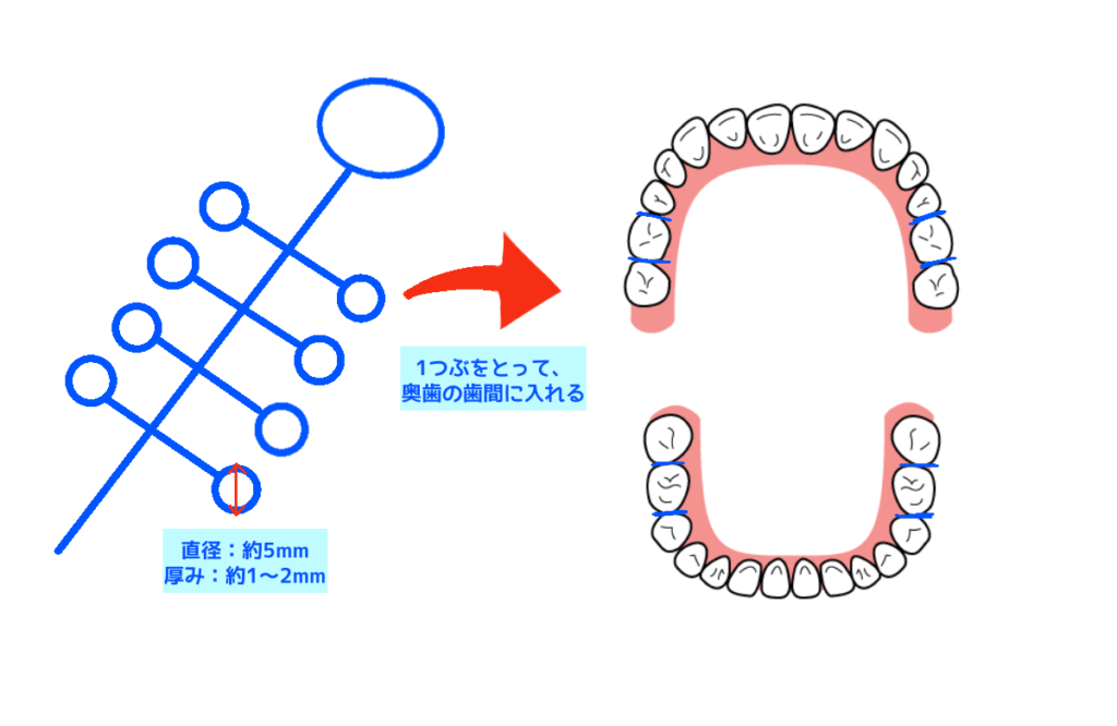 歯列矯正の青ゴムの説明図