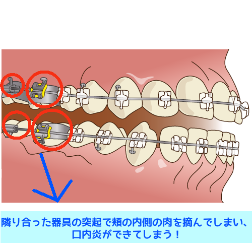 奥歯の矯正器具の突起の説明画像