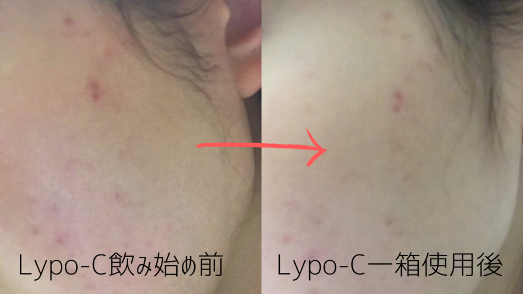 Lypo-C飲み始め前後の肌の変化