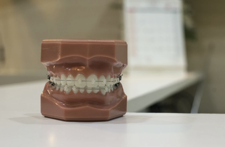 矯正器具か付いた歯の模型