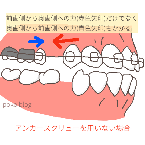アンカースクリューを用いない場合に歯にかかる力の説明図